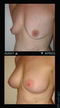 Augmenter des petits seins - prothèse mammaire de forme anatomique