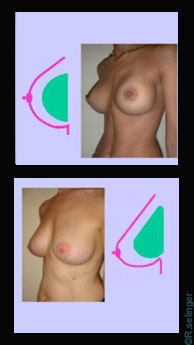 Chirurgie esthétique : augmenter des seins trop petits