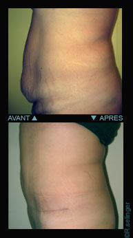 Chirurgie esthtique du corps : plastie abdominale