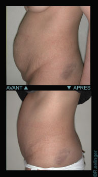 Chirurgie esthtique du corps : plastie abdominale