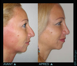 Chirurgie esthétique du visage : nez disgracieux - rhinoplastie