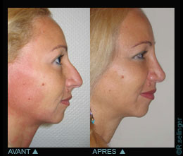 Chirurgie esthtique du visage : nez disgracieux - rhinoplastie