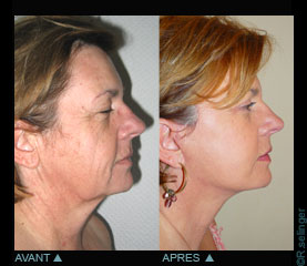 Chirurgie esthétique de rajeunissement du visage : lifting 