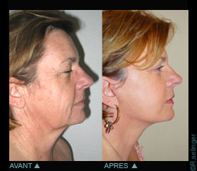 Chirurgie esthtique de rajeunissement du visage : lifting 