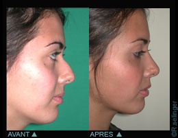 Chirurgie esthétique du visage : nez disgracieux - rhinoplastie