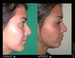 Chirurgie esthétique du visage : nez - rhinoplastie